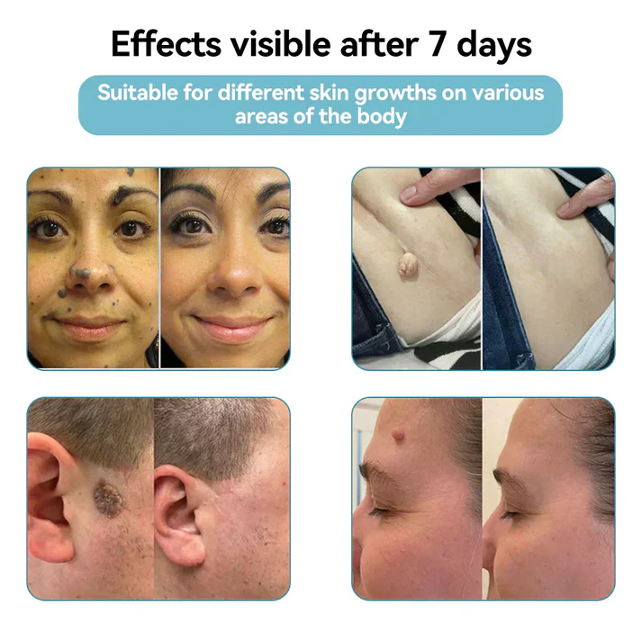 All-in-One CO₂ Laser Eraser Pen | Removes Moles, Warts, Skin Flaws & Pigmentation